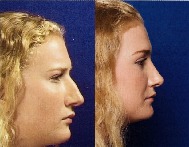 The Nose Clinic Before And After Nose Surgery Photos 40